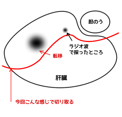 肝臓手術イメージ